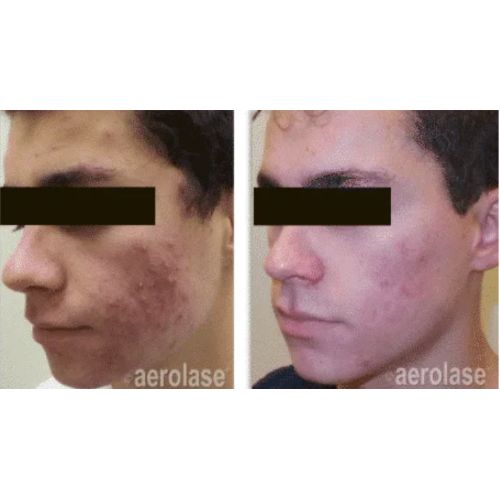 Acne Treatment using Aerolase Before After | Skin and Tonic | Pace, Florida, US