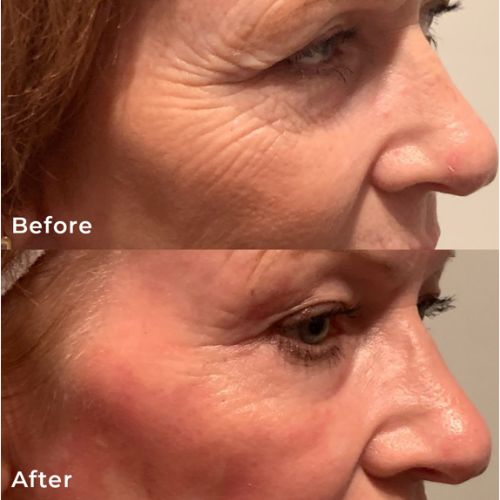 CO2 Resurfacing Laser Before After | Skin and Tonic | Pace, Florida, US