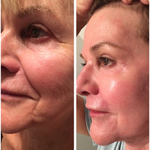 CO2 Resurfacing Laser Before After | Skin and Tonic | Pace, Florida, US