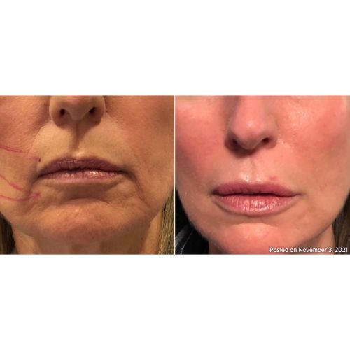 Combintion Therapy Ultherapy, Microneedling, Dermal Fillers Before-After__skinandtonic | Skin and Tonic | Pace, Florida, US