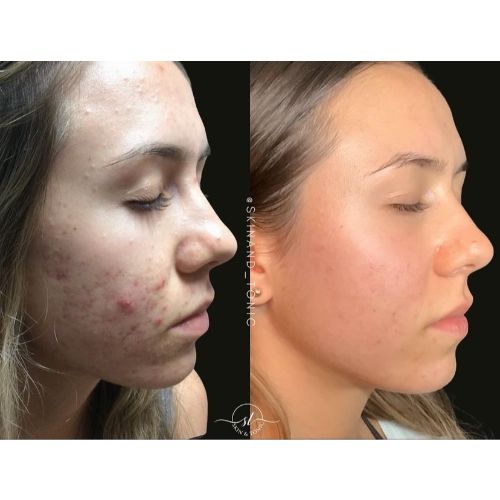 Combintion Therapy ZO Skin Health regimen, Aerolase Neo, Reverse Laser Treatment Before-After__skinandtonic | Skin and Tonic | Pace, Florida, US