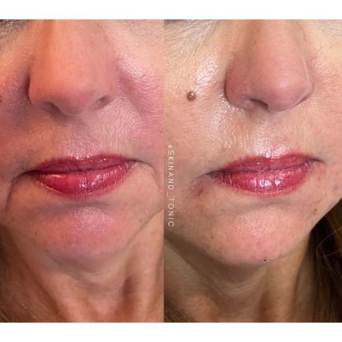 Dermal Filler Before-After skinandtonic | Skin and Tonic | Pace, Florida, US