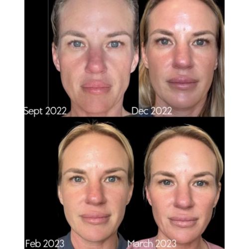 Facial Balancing using Dermal Filler_skinandtonic | Skin and Tonic | Pace, Florida, US