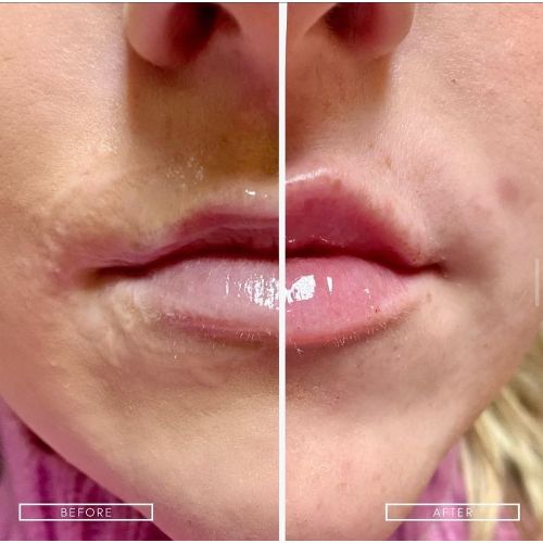 Lip Filler Treatment Before and After | Skin and Tonic | Pace, Florida, US