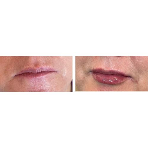 Lip Filler Treatment Before-After_skinandtonic | Skin and Tonic | Pace, Florida, US