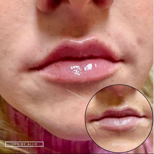Lip Filler Treatment Before-After_skinandtonic | Skin and Tonic | Pace, Florida, US