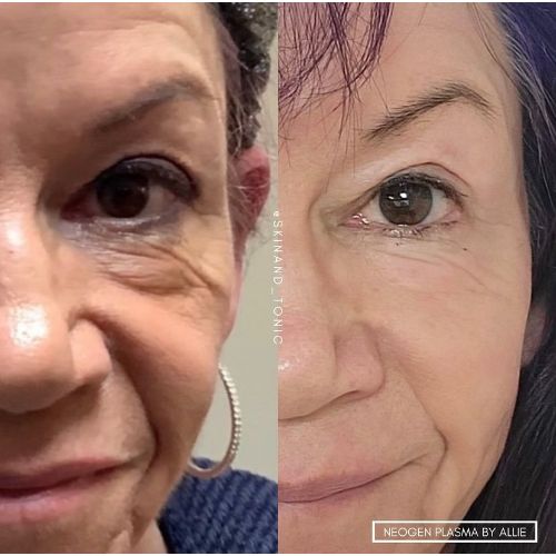 NeoGen Plasma Before After skinandtonic | Skin and Tonic | Pace, Florida, US
