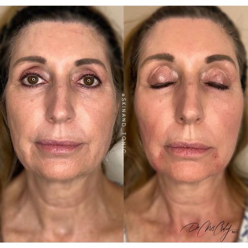 PDO Thread Lift Before After skinandtonic | Skin and Tonic | Pace, Florida, US