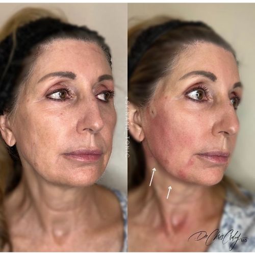 PDO Thread Lift Before After skinandtonic | Skin and Tonic | Pace, Florida, US