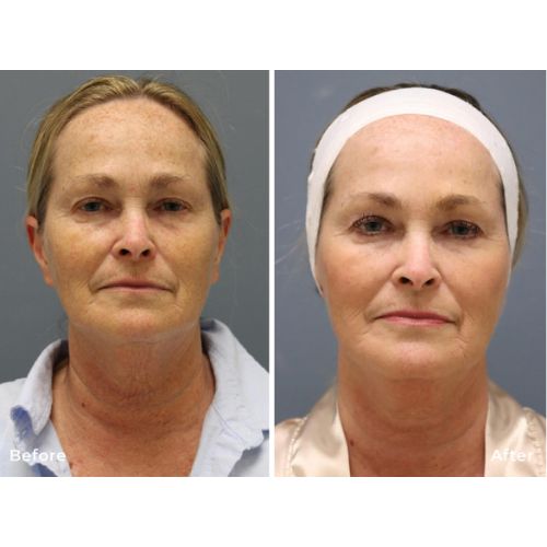 RF Microneedling Before After skinandtonic | Skin and Tonic | Pace, Florida, US