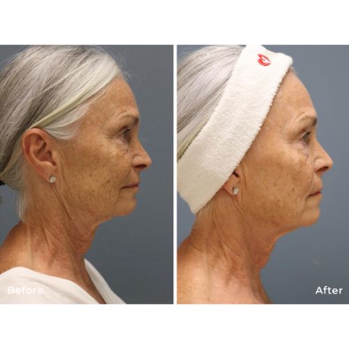 RF Microneedling Before After skinandtonic | Skin and Tonic | Pace, Florida, US