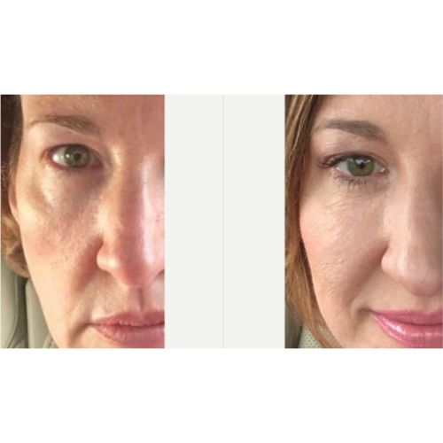 Radiesse Before After skinandtonic | Skin and Tonic | Pace, Florida, US