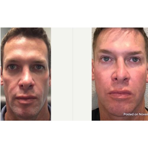 Sculptra Before After skinandtonic | Skin and Tonic | Pace, Florida, US