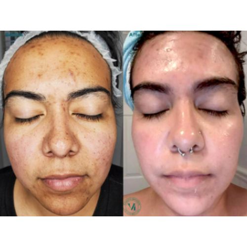 VI Peel (Chemical Peel) Before After skinandtonic | Skin and Tonic | Pace, Florida, US