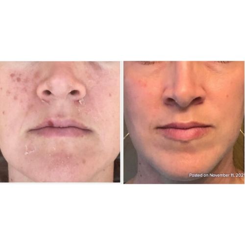 VI Peel (Chemical Peel) Before After skinandtonic | Skin and Tonic | Pace, Florida, US