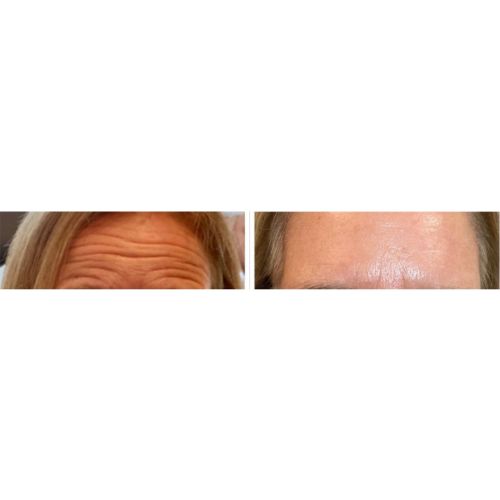 Dysport Before After skinandtonic | Skin and Tonic | Pace, Florida, US
