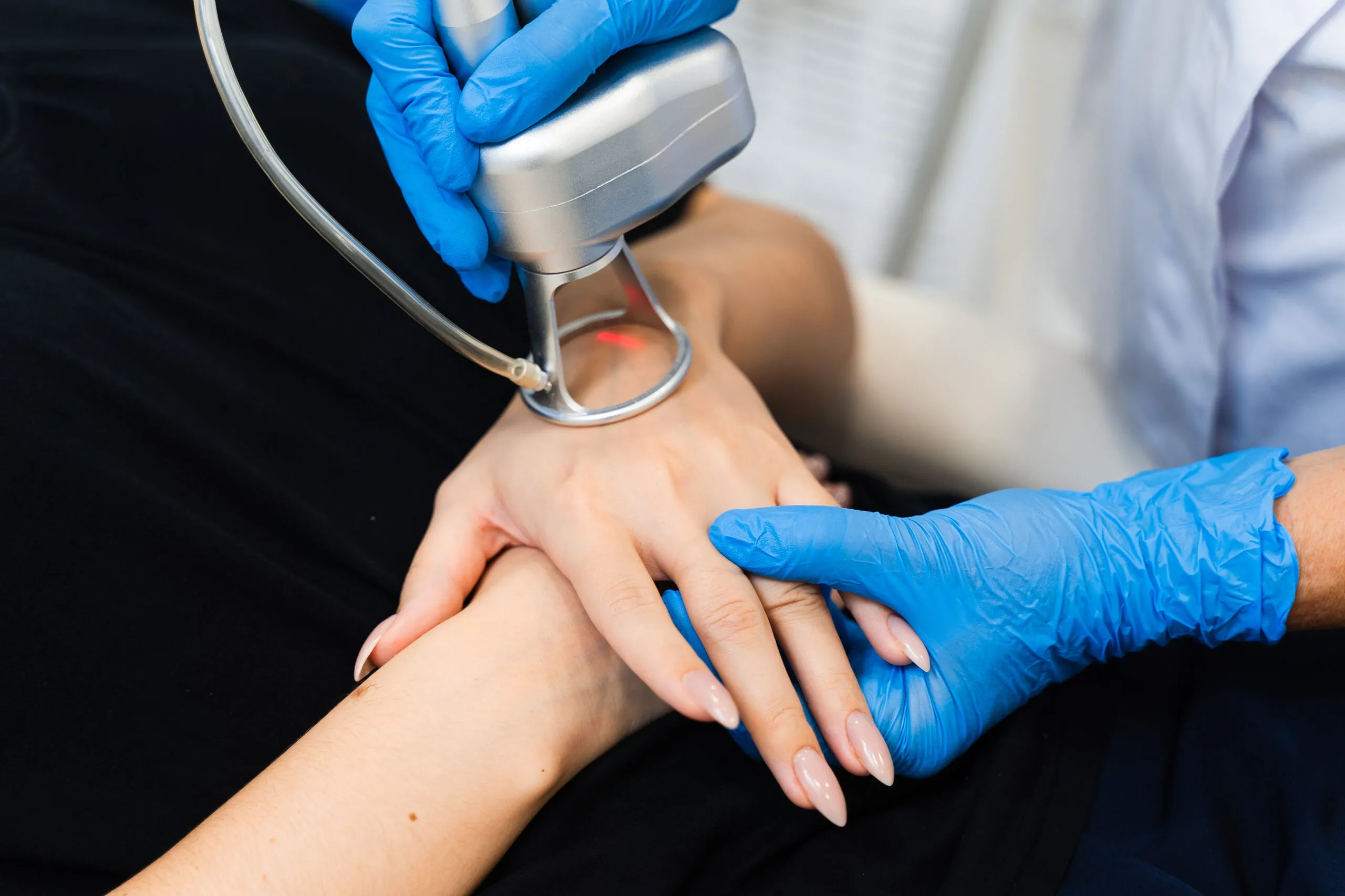 CO2 Laser for Hand Rejuvenation by skin and tonic in Pace, FL