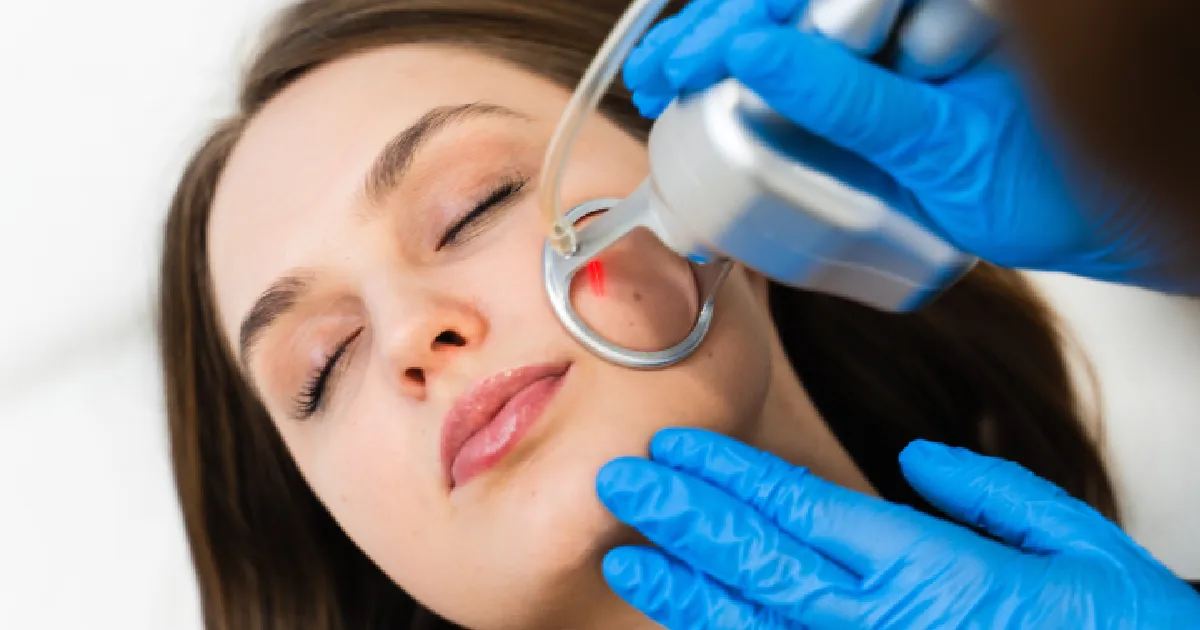 A Woman Receiving Laser Resurfacing Treatment in Pace, FL