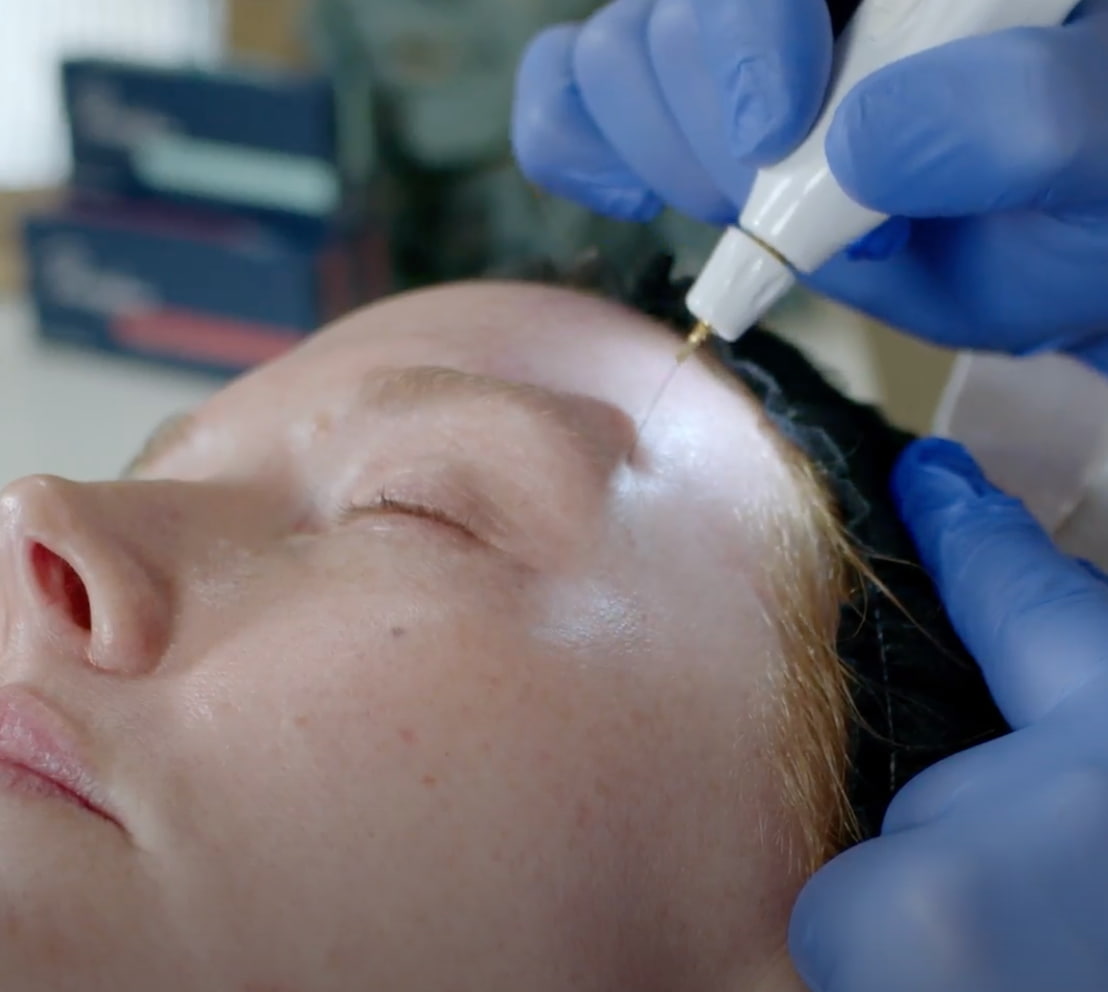 Plexr Treatment by Skin and Tonic in Pace, FL